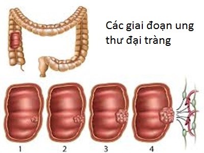 Phương pháp mới điều trị ung thư đại trực tràng giúp giảm độc tính hóa trị, giảm tác dụng phụ, đáp ứng với quá trình chữa trị tốt hơn. (Thời sự đêm 31/01/2018)